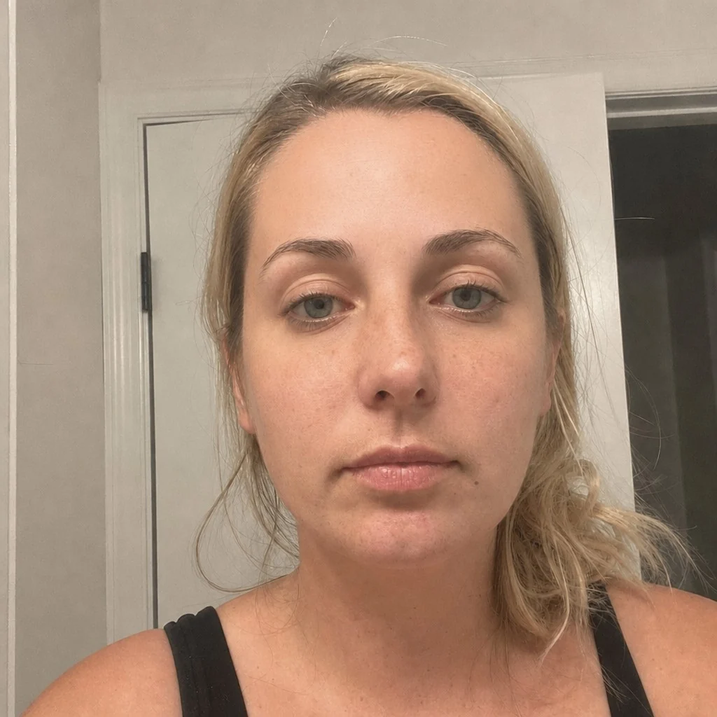 Botox simulation, after