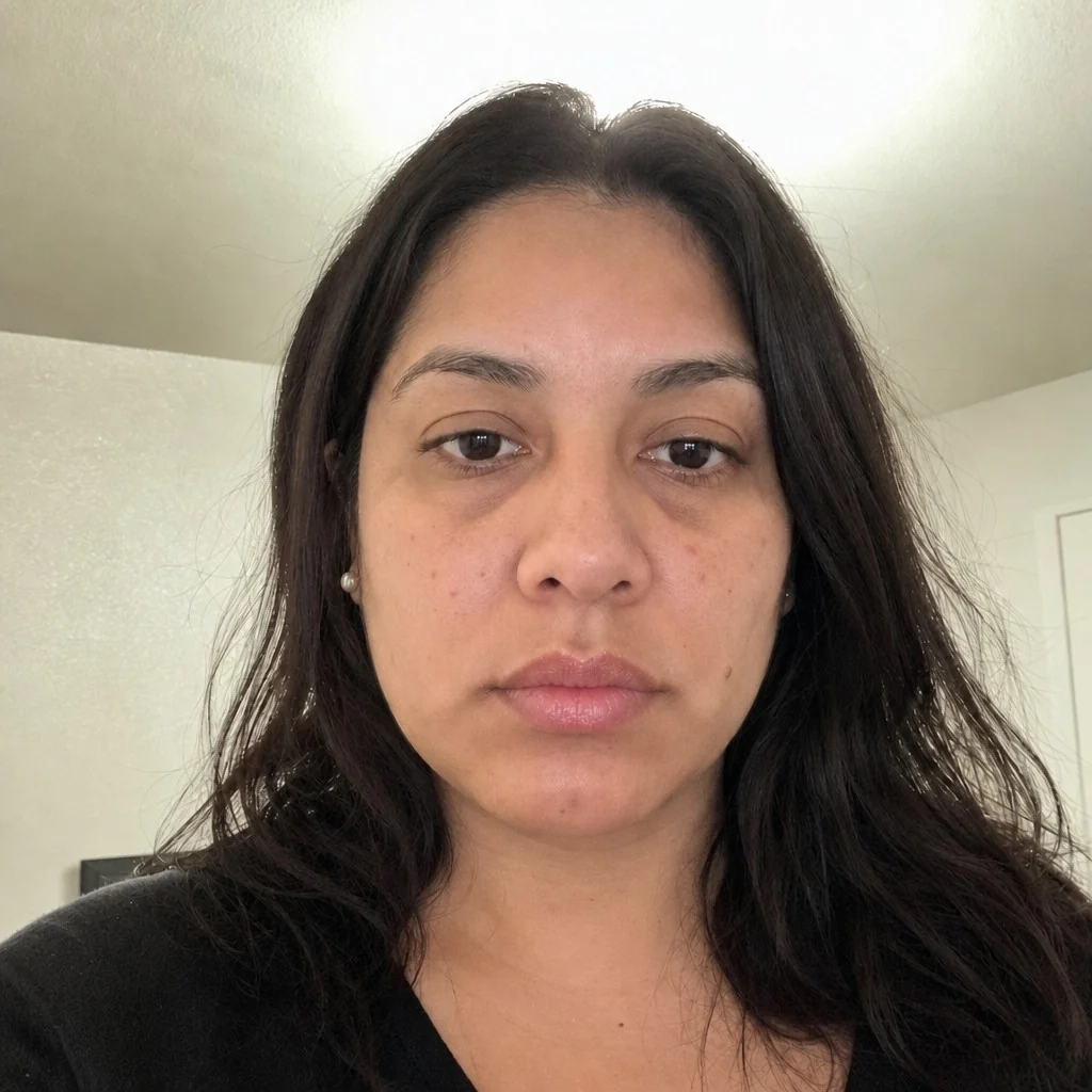 Lip Filler simulation, after